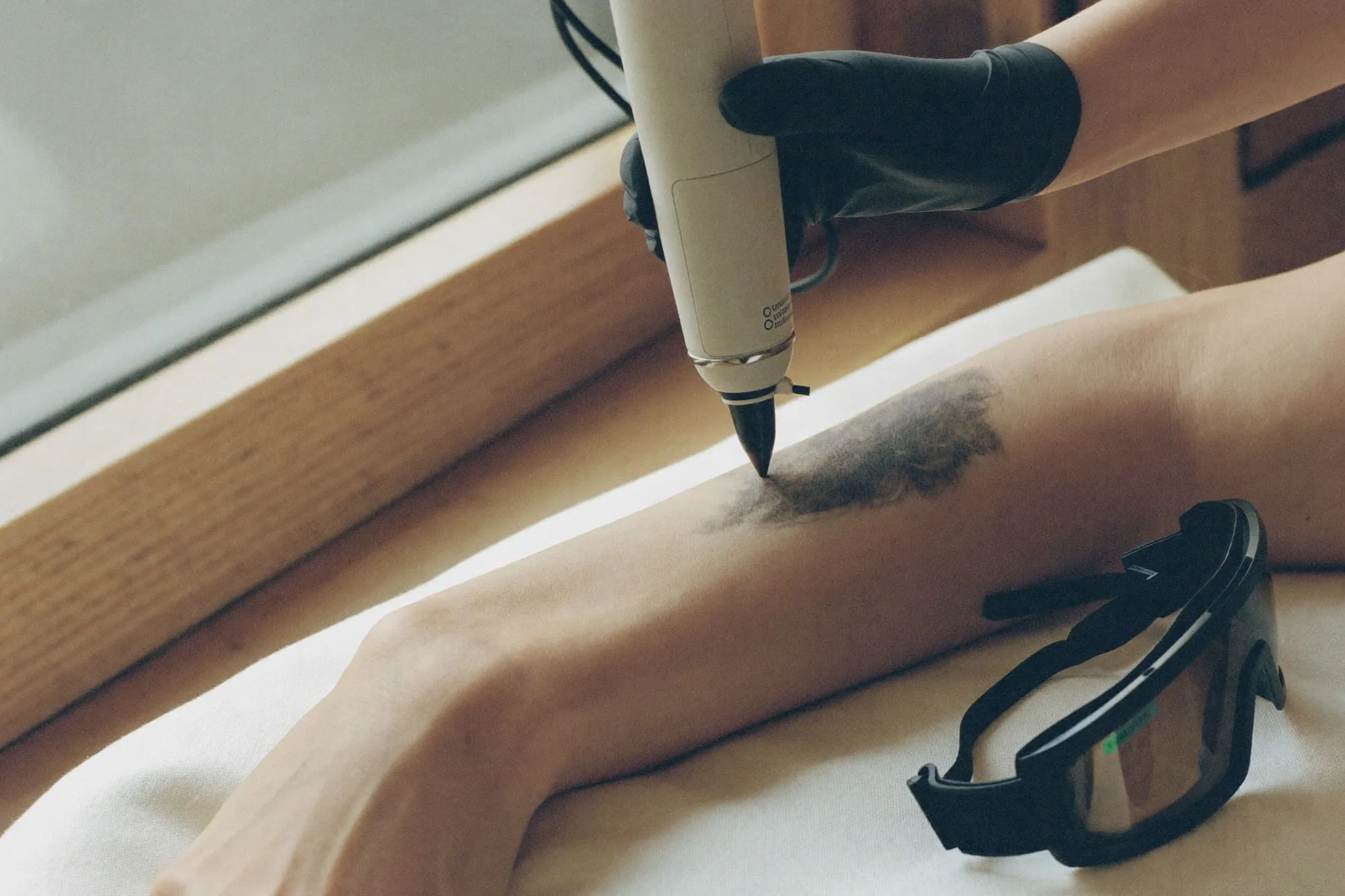 Remoção de tatuagem a laser na Bella Laser Clinic, no Porto