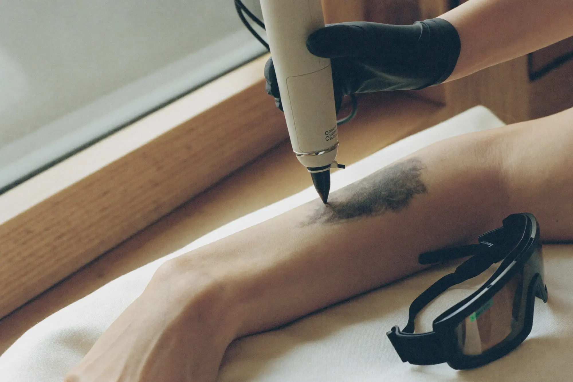 Remoção de tatuagem a laser na Bella Laser Clinic, no Porto